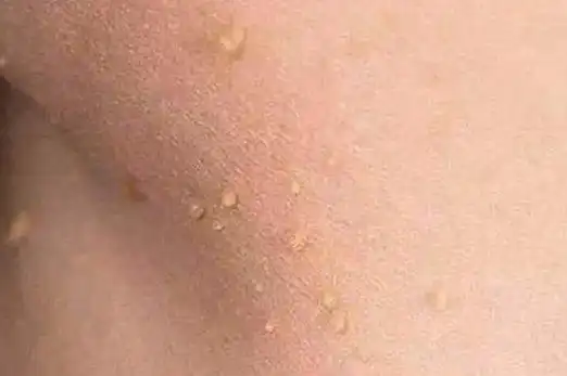 丝状疣与hpv感染相关,当皮肤出现破损时,病毒可进入表皮