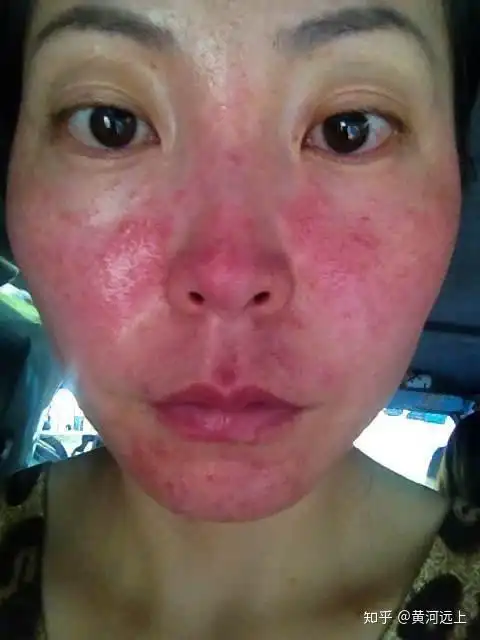 面部红血丝的成因及防治手段