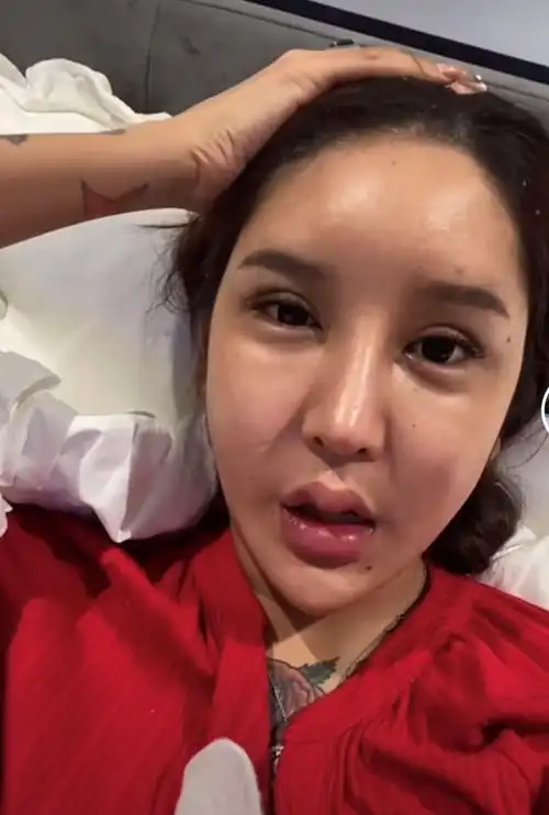 整容又失败,花费百万额头却现巨坑,曾面部神经遭压迫险失明_腾讯新闻