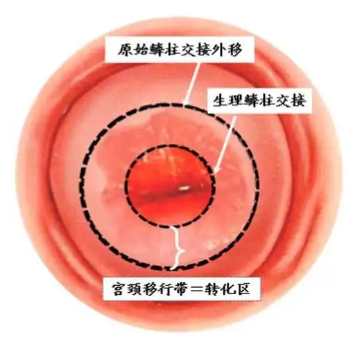 新生的鳞状上皮覆盖宫颈腺管口或伸入腺
