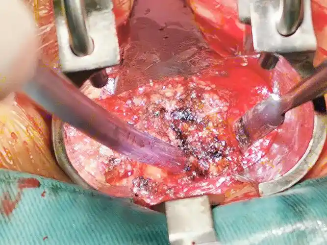 改良的mis-tlif技术:腰椎微创融合经典手术,不额外增加费用的手术.