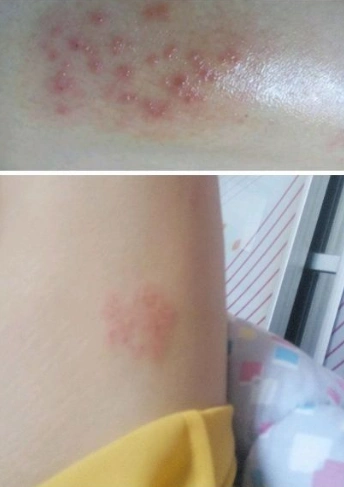 蜘蛛疮早期症状图片 (13)_有来医生