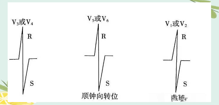 心电轴的精确测量与心脏长轴转位的判定方法