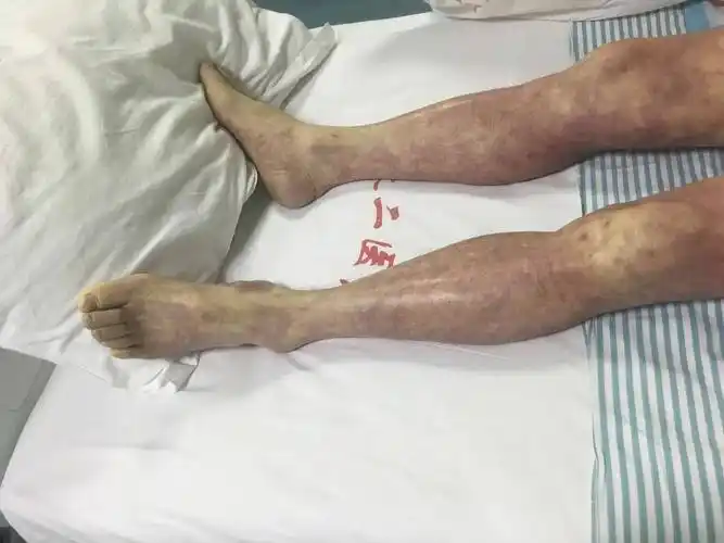 我们icu收了一个"脓毒症"引起的感染性休克的病人,皮肤开始是花斑状