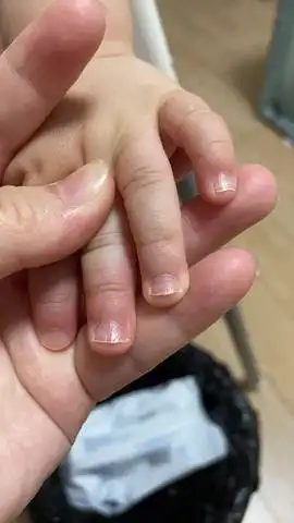 两岁宝宝手指甲是这样的,是缺什么维生素?