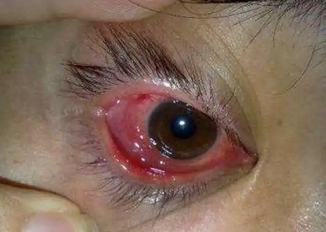 风热邪气循肝经上炎,如果到达眼睛就会使眼睛火气增大,从而使眼球红肿