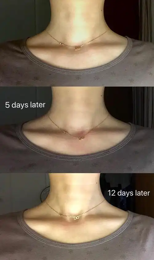 我本身就左右不对称,感觉做了之后是不是高低锁骨更明显了啊?