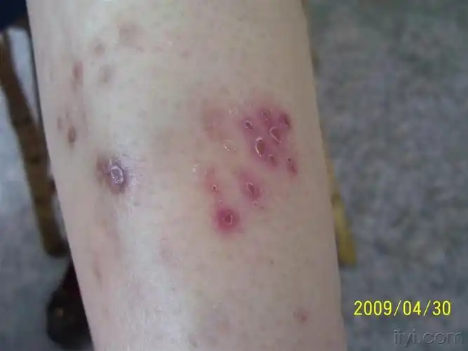 斑丘疹  糖尿病