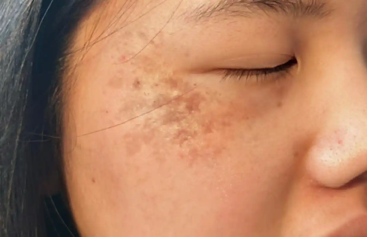 太阳晒的黑斑是许多人在阳光暴晒下常见的皮肤问题.