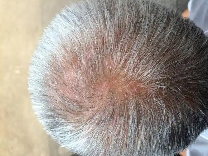 老人的了皮肤病,这是什么皮肤病,怎么医治,这种很痒,如图