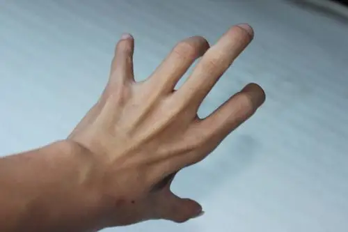 你好,医生,我的左手肌肉萎缩,无名指不听使唤,伸不直,已经有几年了