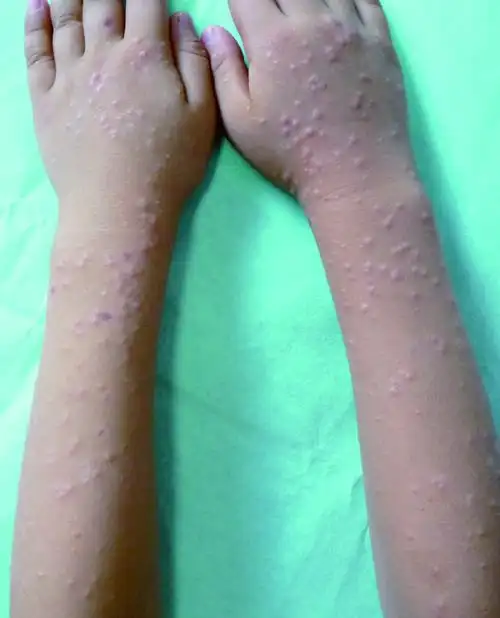 皮肤性病科图谱: 病毒性皮肤病 儿童丘疹性肢端皮炎