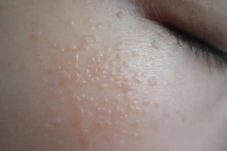 眼部扁平疣