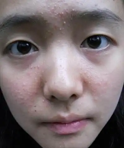 闭口粉刺图 (76)