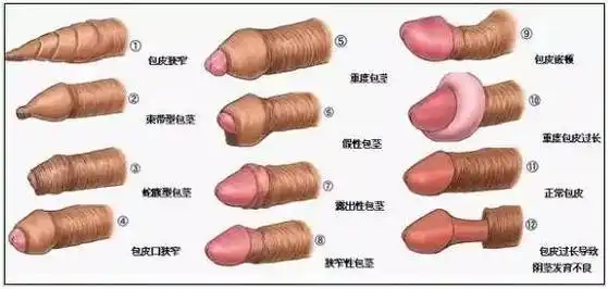 包茎是怎样形成的