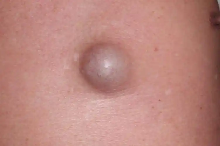 男性皮脂腺囊肿