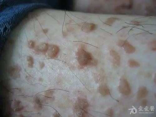 楼主苦丁茶1682013-04-12 10:15:13   疣状肢端