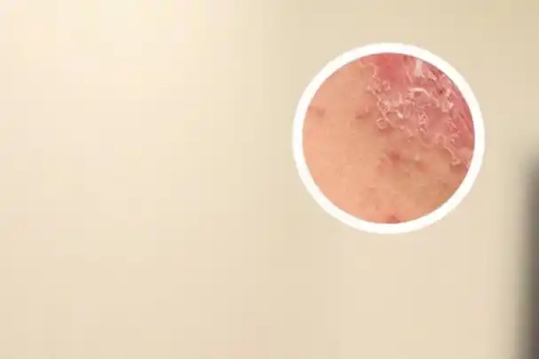 皮肤起干皮像癣一样图片-身上起了好多干皮像癣一样-手机名医汇