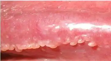 冠状沟珍珠疹图片