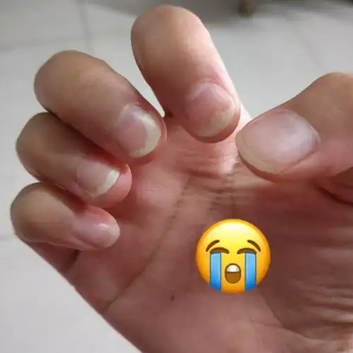 检查也不是灰指甲,也不知道怎么了,各位有跟我一样的手指吗#灰指甲 吗