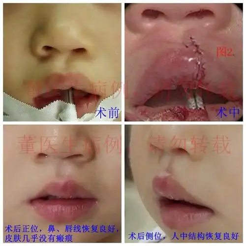 给隐性唇裂患儿家长答疑解惑