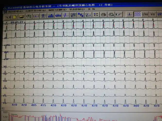 二度1型房室传导阻滞 - 心电图脑电图专业讨论版 - 爱爱医医学论坛