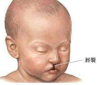 生下"兔唇"宝宝,产妇声称自己吃过兔肉?医生怒斥:没常识