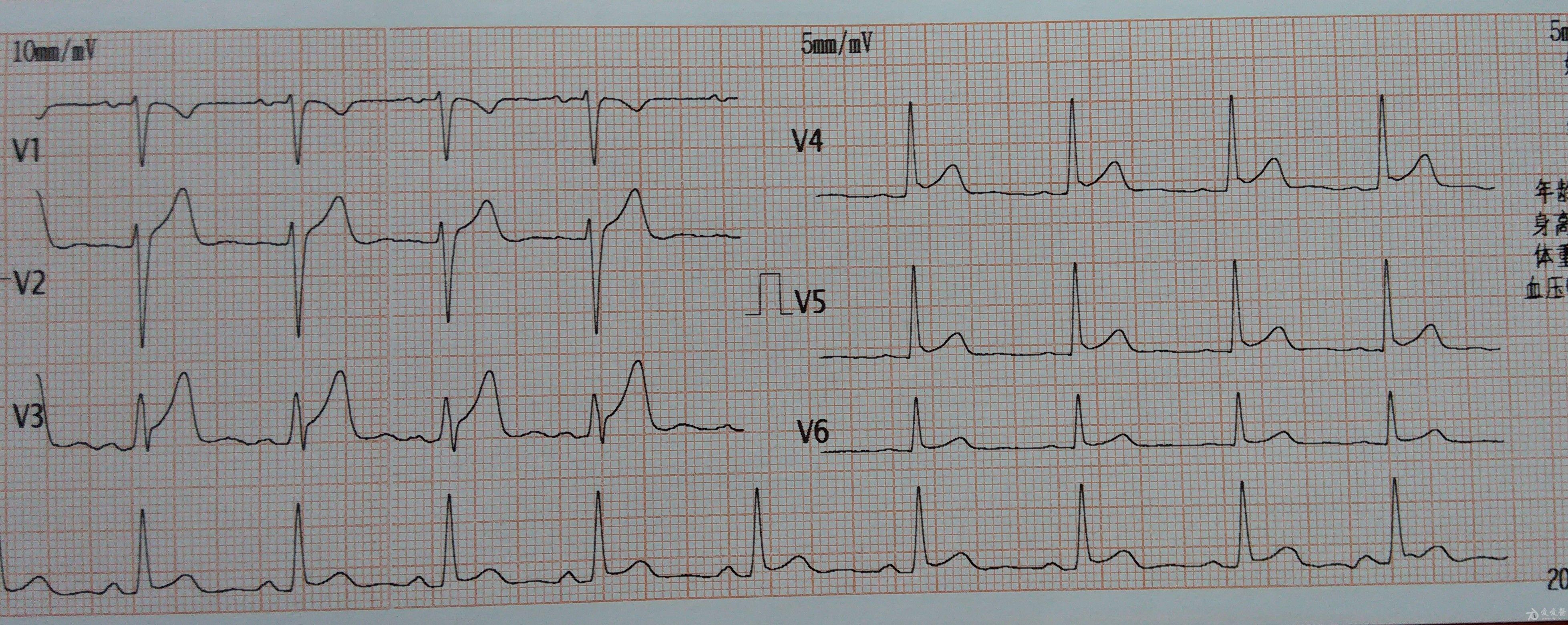 这心电图st段抬高吗