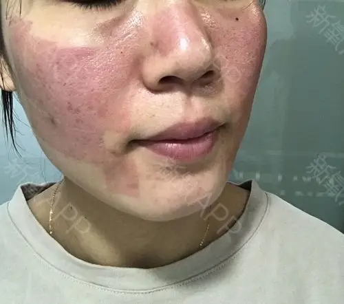 南昌光子嫩肤好不好_效果图_氧气0w6wp光子嫩肤术后第0天_新氧美容