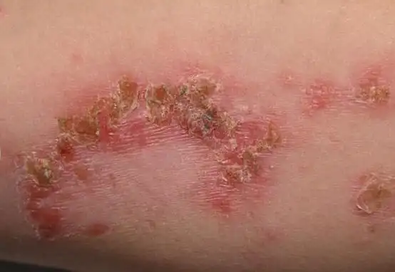 答案及解析│5个细菌性皮肤感染小问答