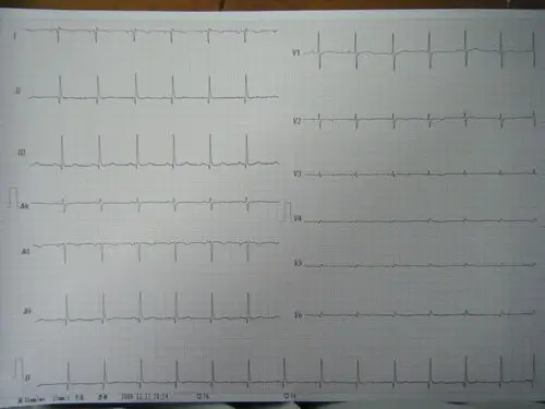 右位心者心电图 - 心电图脑电图专业讨论版 - 爱爱医医学论坛