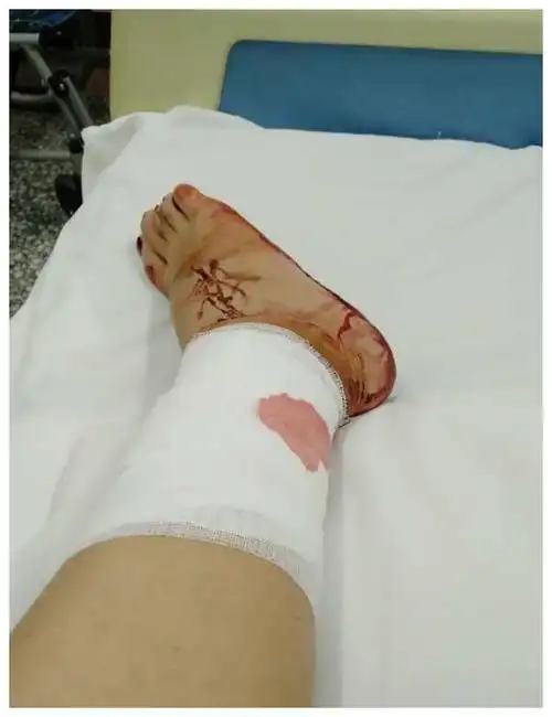 孕妇家中被炸伤伤口长达七厘米这种爆炸物你身边可能也有