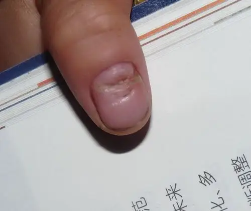 儿科 小儿外科 小儿指甲-髌骨综合征