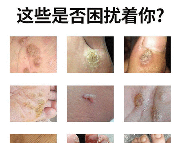 疣克舒软膏去面部扁平脸部疣脖子丝状优手足去除寻常尤去除膏跖尤净