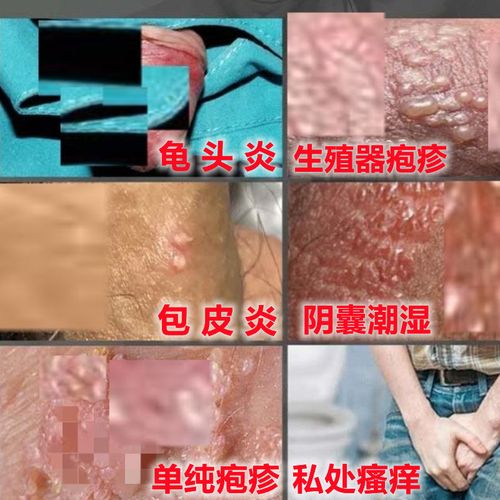 治疗梅毒淋病流脓性病一扫光尿道炎感染生殖疱疹防复发克星药膏