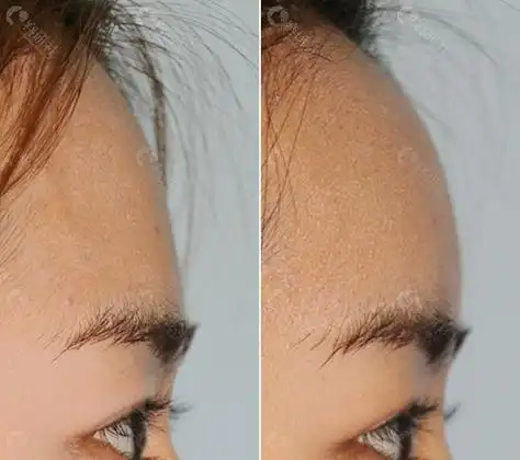 爱护医院额头填充对比照