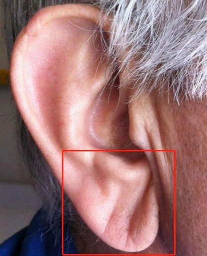 极速真探耳垂有褶皱预示冠心病医生没有直接相关性