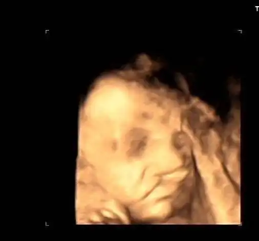 怀孕6个月,检查出孩子"唇腭裂",询问原因后,医生:太无知!