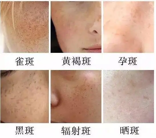 脸部色斑 是指脸部和周围颜色不同的斑点 体现在脸上 就是各种碍眼的