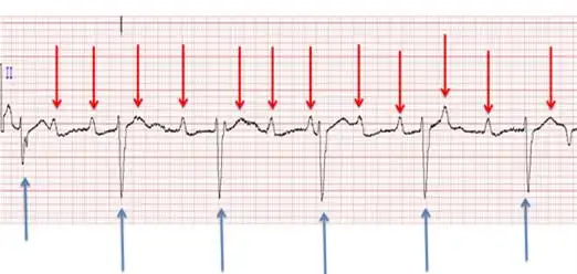 图文并茂|三度房室传导阻滞
