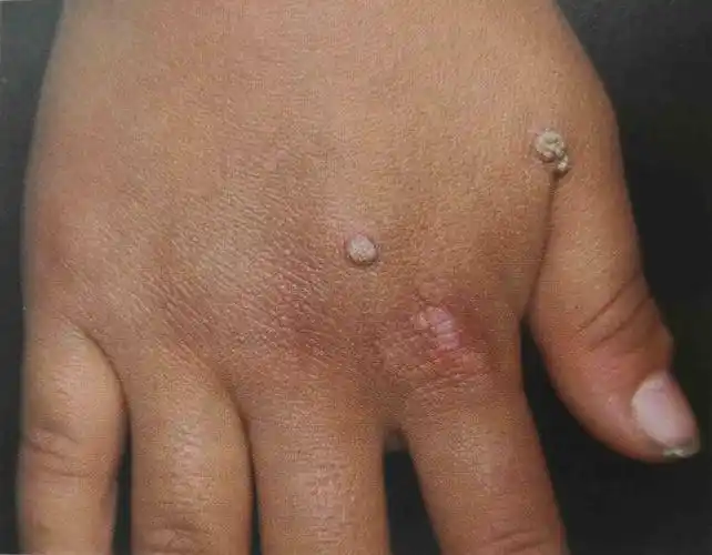 长疙瘩菜花状,菜花状的疙瘩图片_大山谷图库