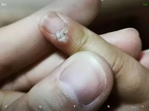 小朋友手指上长了个什么东西求助有图慎入
