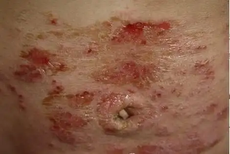 男性淋病可以分为急性淋病和慢性淋病.