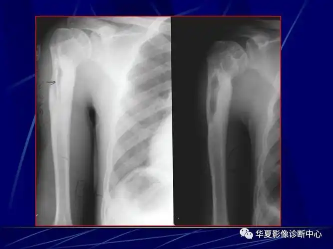 骨化脓性骨髓炎的影像学诊断