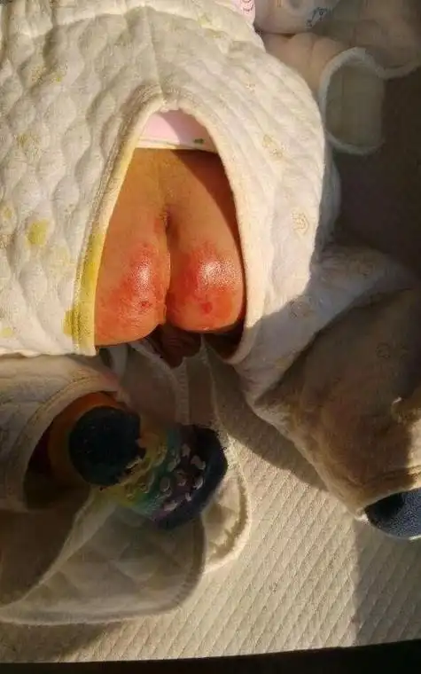 女宝宝小便处两侧发红怎么办,5个月女宝宝尿道口发红怎么办图4