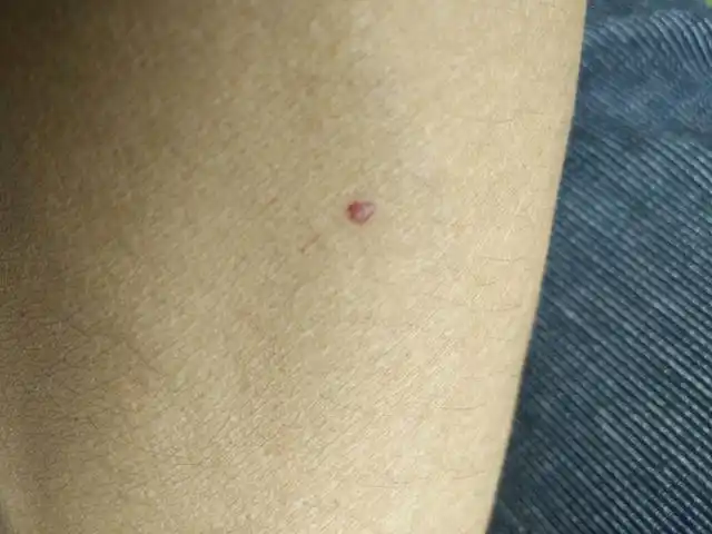 (二)并发症樱桃血管瘤的临床症状是多发的皮肤损伤,常发生在躯干和