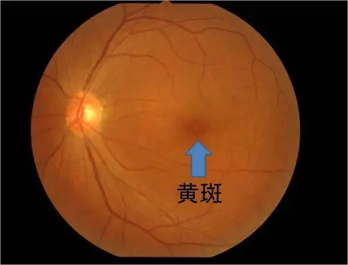 这是一张正常的眼底照片,黄斑是人视力的中心,这里若是有病变,视力