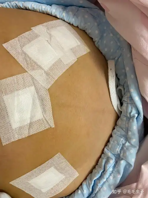 7cm子宫肌瘤腹腔镜手术记录-已出院补充术后情况 - 知乎