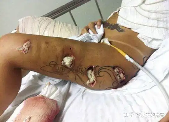 想做大腿吸脂的你兔子给你一些建议吸脂的费用和效果