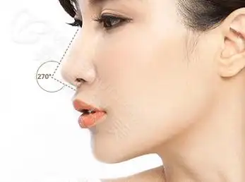 这种鼻形的特点是从侧面看,鼻尖有微微上翘,高出鼻梁2~4mm,s型的鼻子